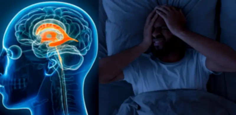 Dolor de cabeza que mejora al acostarse: señal clave de hipotensión intracraneal