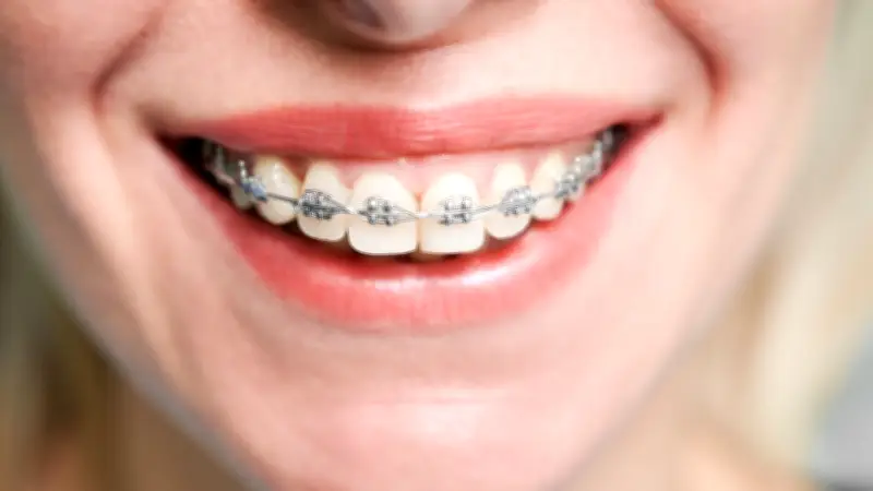 Invima alerta sobre riesgos de comprar dispositivos de ortodoncia en redes sociales