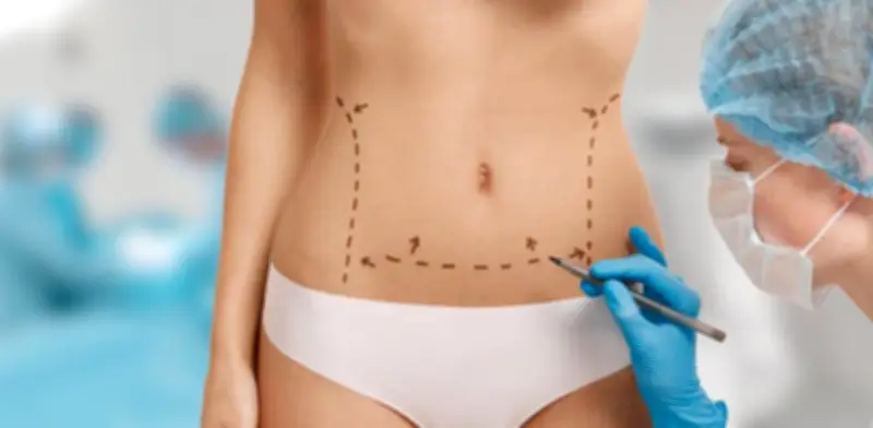 Liposucción lidera cirugías estéticas en Colombia con más de 41.000 procedimientos anuales