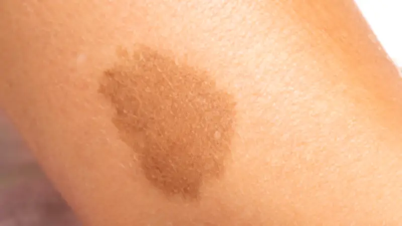 Manchas cafés en niños: síntoma clave de la neurofibromatosis tipo 1