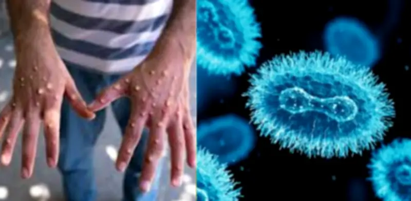 Minsalud confirma primer caso de viruela del mono clado 1B en Antioquia