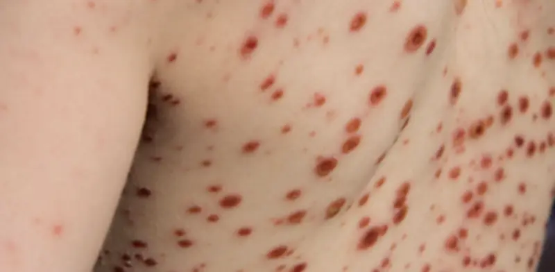 Varicela aumenta 15% en Colombia durante 2026: Departamentos con mayores incrementos