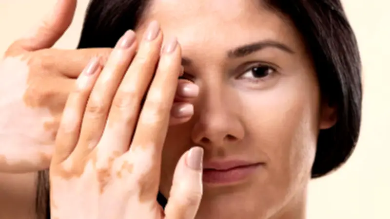 Vitiligo: la enfermedad de la piel que padecía Michael Jackson