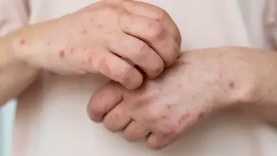 Alerta por sarampión en Colombia: casos importados y riesgo de propagación