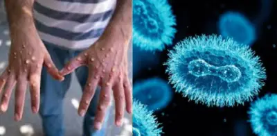 Minsalud confirma primer caso de viruela del mono clado 1B en Antioquia