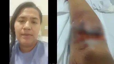 Paciente de Suba denuncia demora en cirugía tras accidente en bicicleta