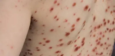 Varicela aumenta 15% en Colombia durante 2026: Departamentos con mayores incrementos