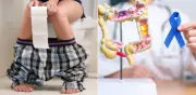 Cáncer de colon: cambios en heces que alertan un problema grave