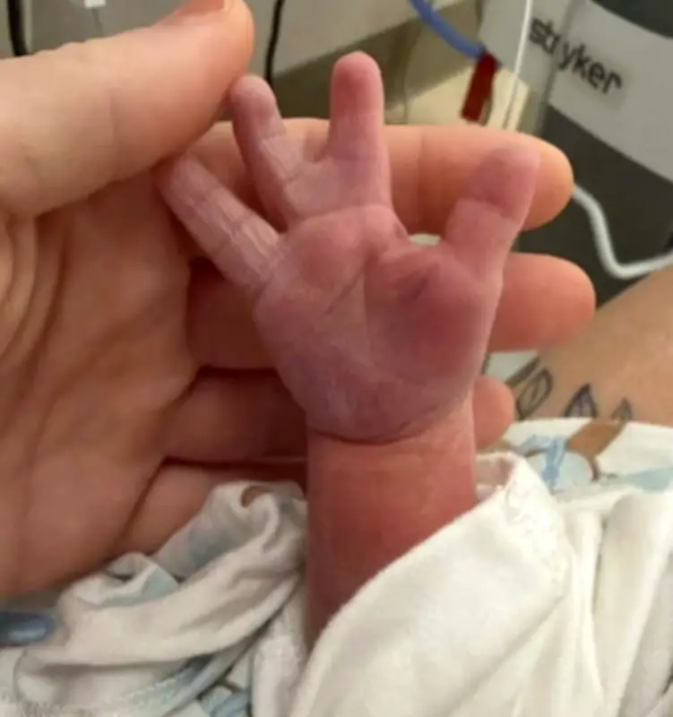 Bebé con rara condición en mano se vuelve viral: "su aleta de la suerte"