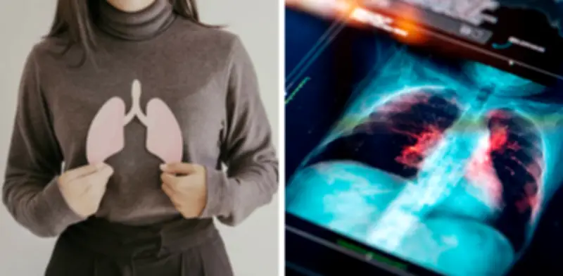 Cinco síntomas persistentes que alertan sobre cáncer de pulmón y requieren evaluación médica