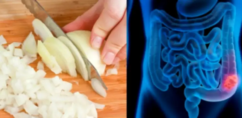 Compuesto de cebolla podría combatir el cáncer de colon, según estudio
