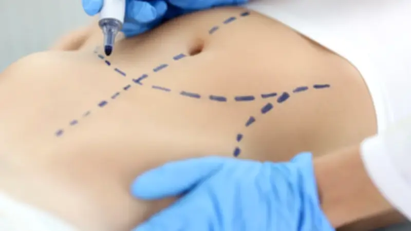 Los cuatro pilares de seguridad para una liposucción segura