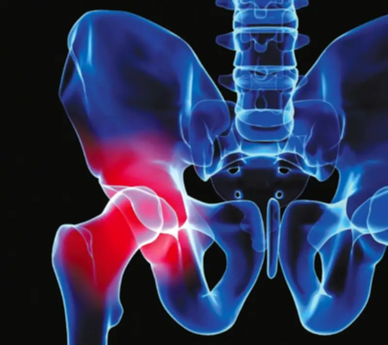 Osteoporosis en Colombia: una epidemia silenciosa de fracturas