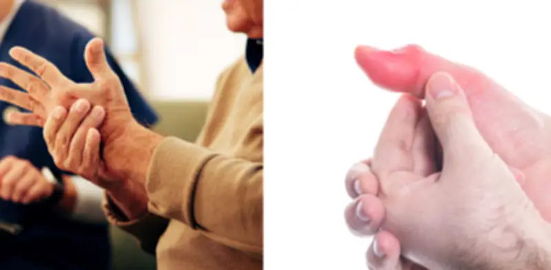 Señales tempranas de artritis que ignoras y cómo prevenirla