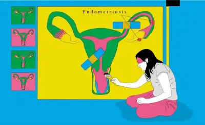 Endometriosis: juez ordena a Minsalud responder sobre política pública