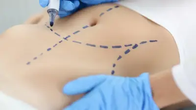 Los cuatro pilares de seguridad para una liposucción segura