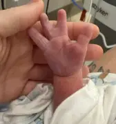Bebé con rara condición en mano se vuelve viral: 