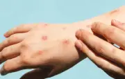 Bogotá confirma primer caso de mpox variante clado Ib