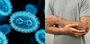 Confirman segundo caso de mpox clado Ib en Colombia detectado en Bogotá